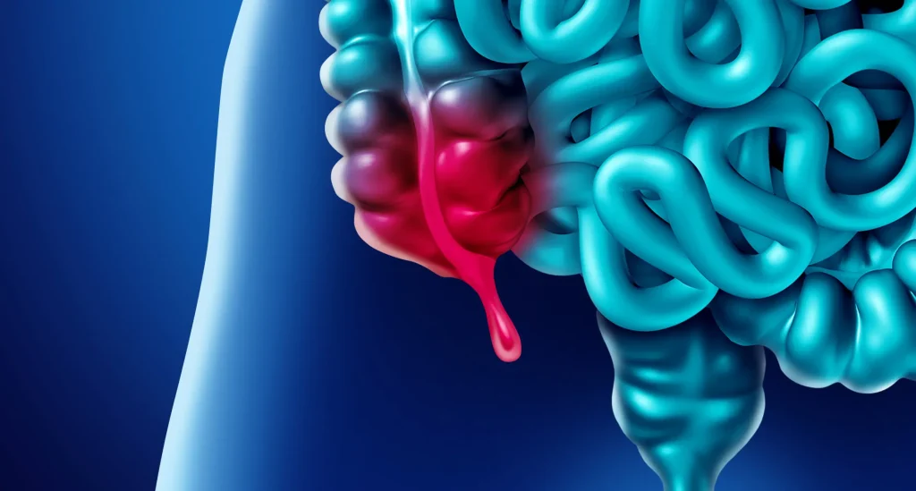 Ist das Parkinson-Risiko im Darm erkennbar: neue Studie liefert Hinweise