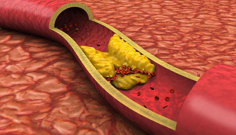 Hohes Cholesterin – Ursache und was tun: Diese Schritte sind jetzt wichtig