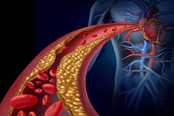 Hohes Cholesterin – Ursache und was tun: Diese Schritte sind jetzt wichtig